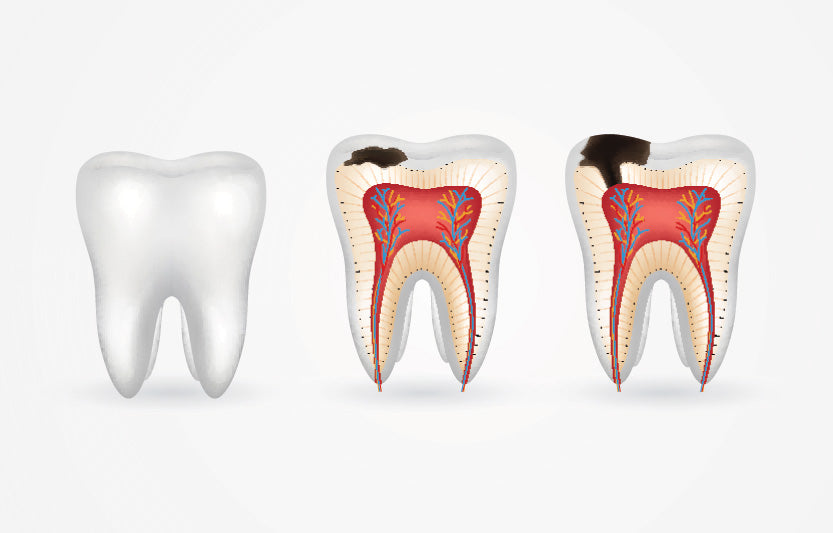 Tooth Cavities: Symptoms, Causes and Ayurvedic Treatment ayurchemstore